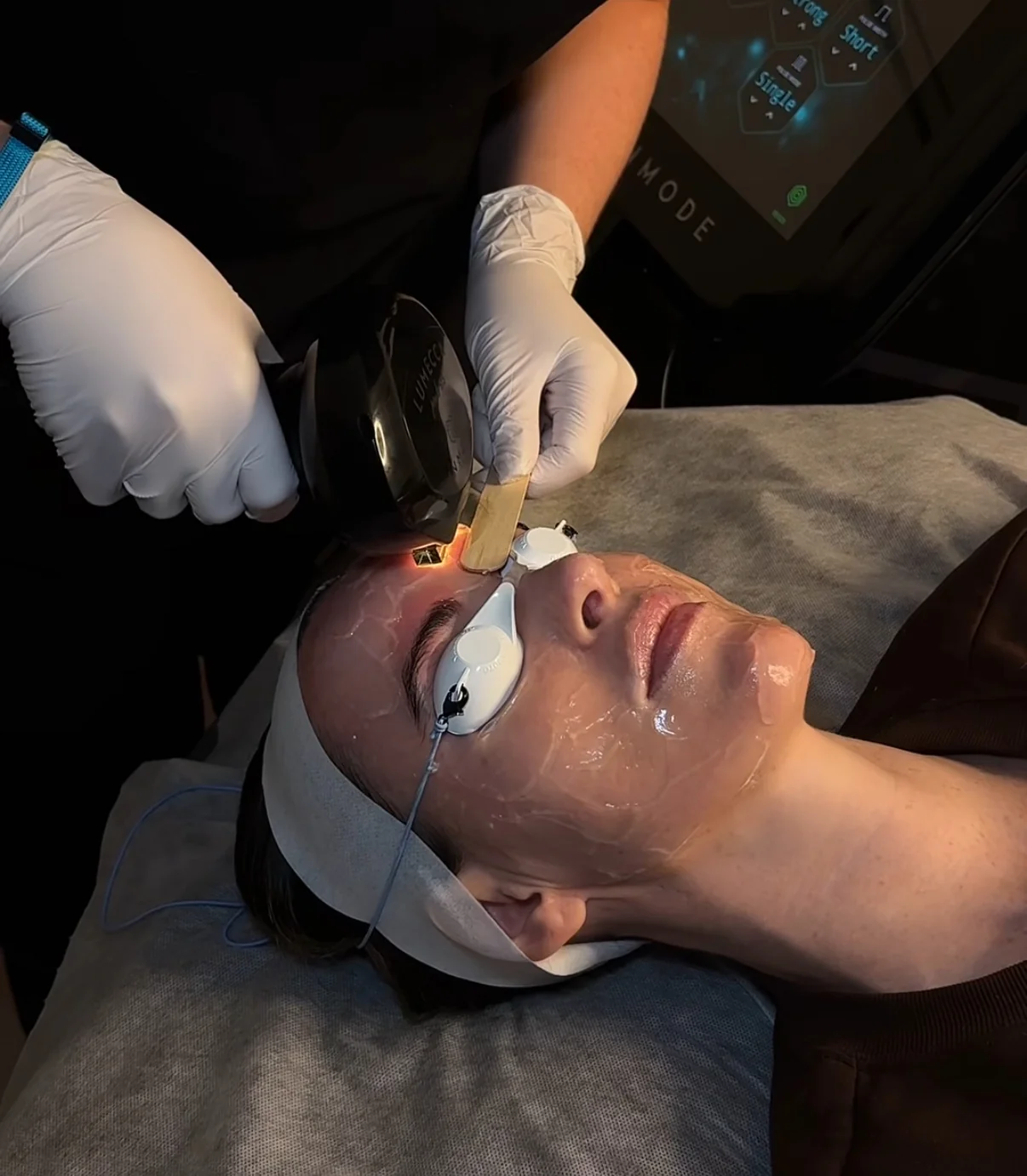 Age Spots treatment at FACE Weybridge