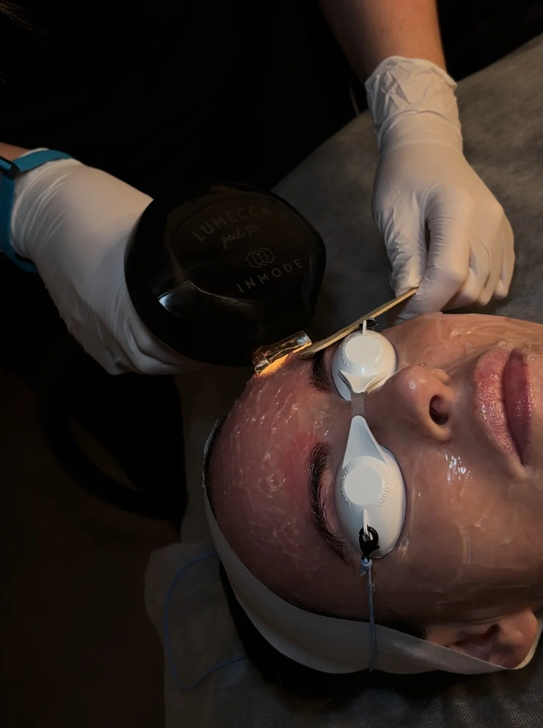 Sun Damage treatment at FACE Weybridge